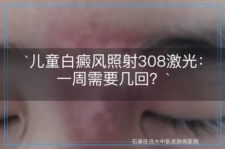 `儿童白癜风照射308激光：一周需要几回？`