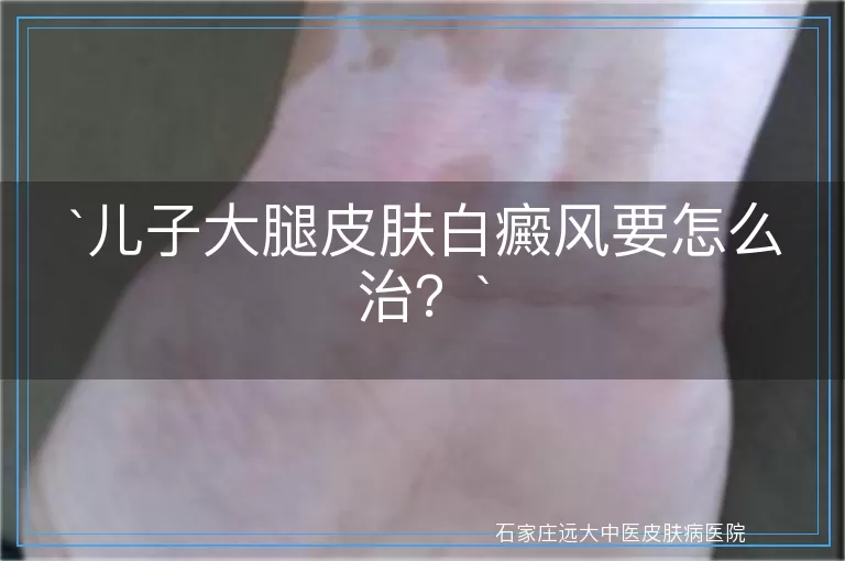 `儿子大腿皮肤白癜风要怎么治？`