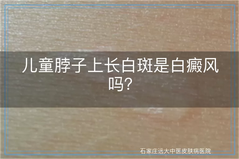 儿童脖子上长白斑是白癜风吗？