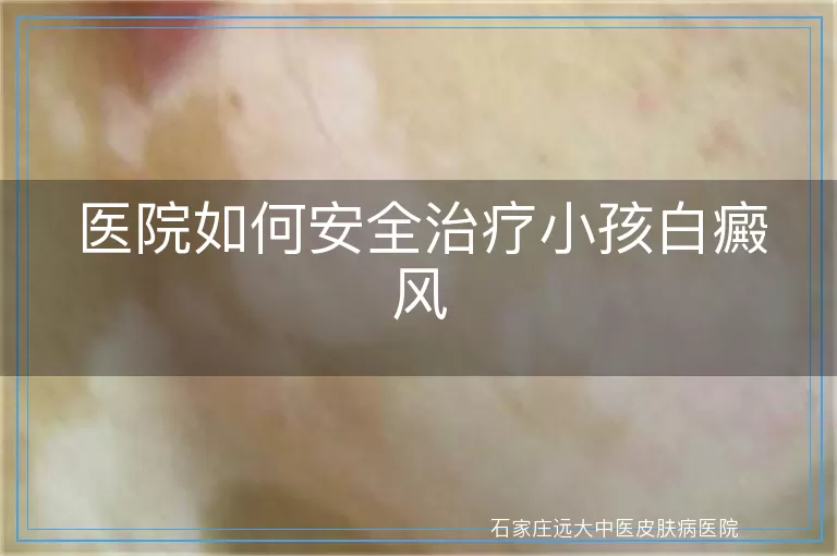 医院如何安全治疗小孩白癜风