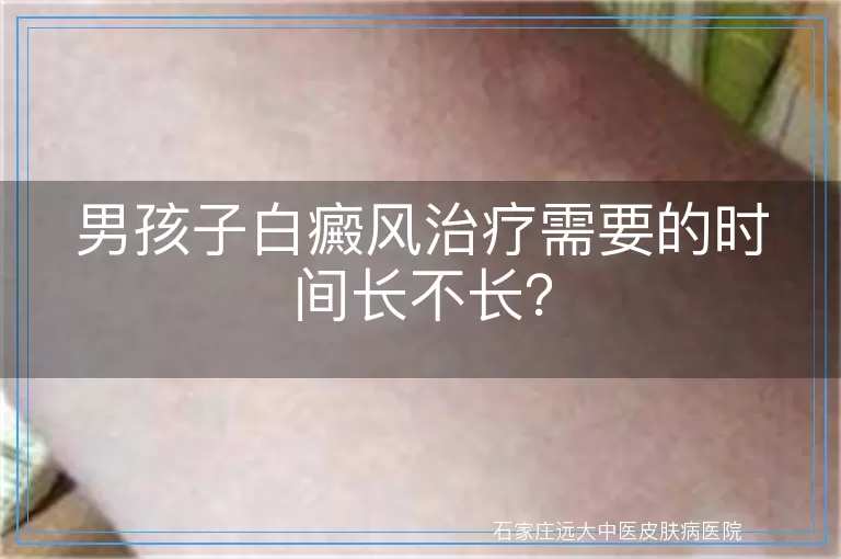 男孩子白癜风治疗需要的时间长不长？