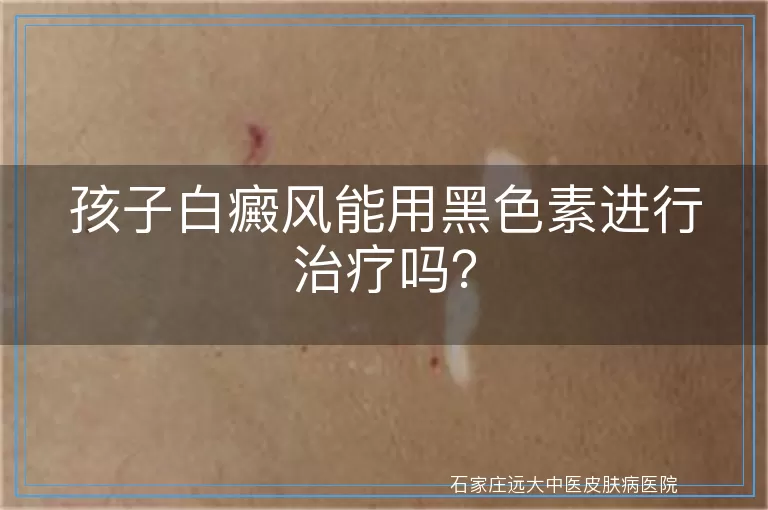 孩子白癜风能用黑色素进行治疗吗？