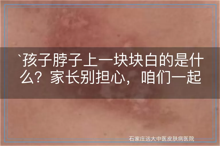 `孩子脖子上一块块白的是什么？家长别担心，咱们一起来了解`