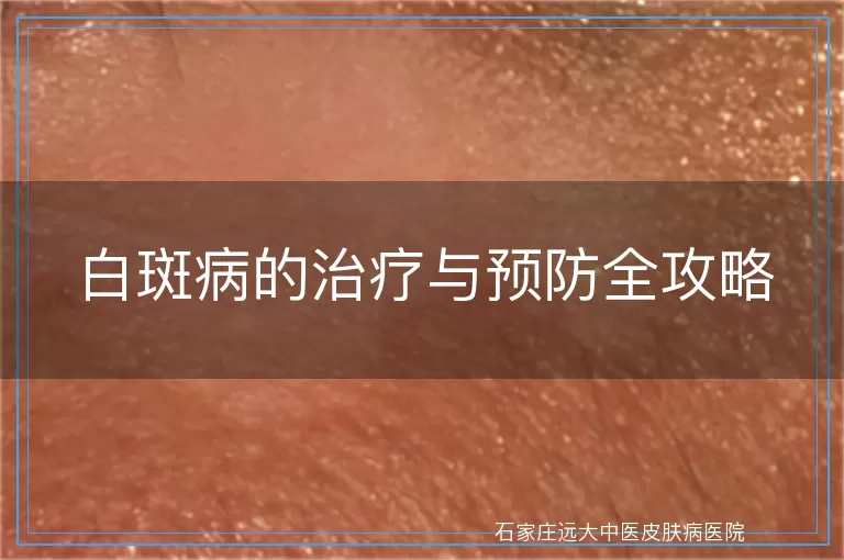 白斑病的治疗与预防全攻略