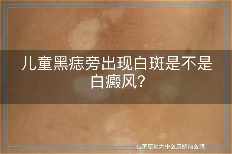 儿童黑痣旁出现白斑是不是白癜风？