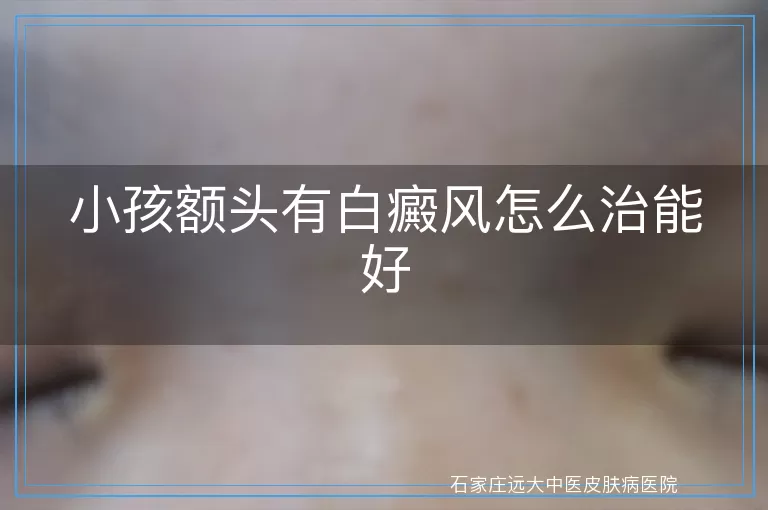 小孩额头有白癜风怎么治能好