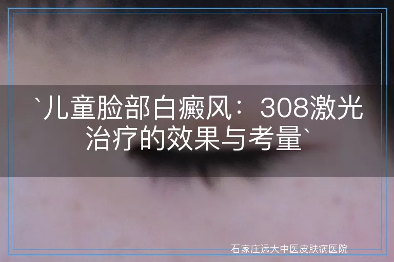 `儿童脸部白癜风：308激光治疗的效果与考量`