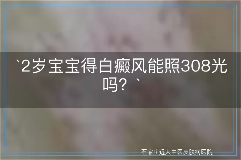 `2岁宝宝得白癜风能照308光吗？`