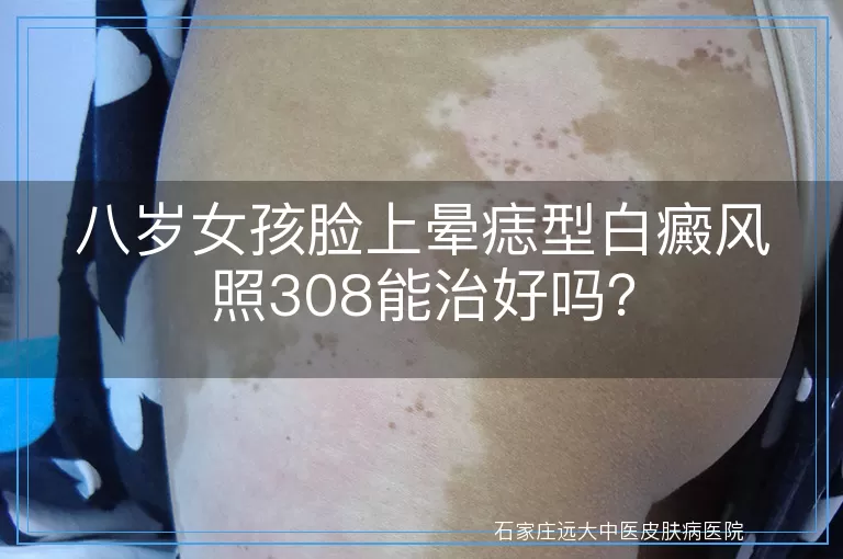 八岁女孩脸上晕痣型白癜风照308能治好吗？