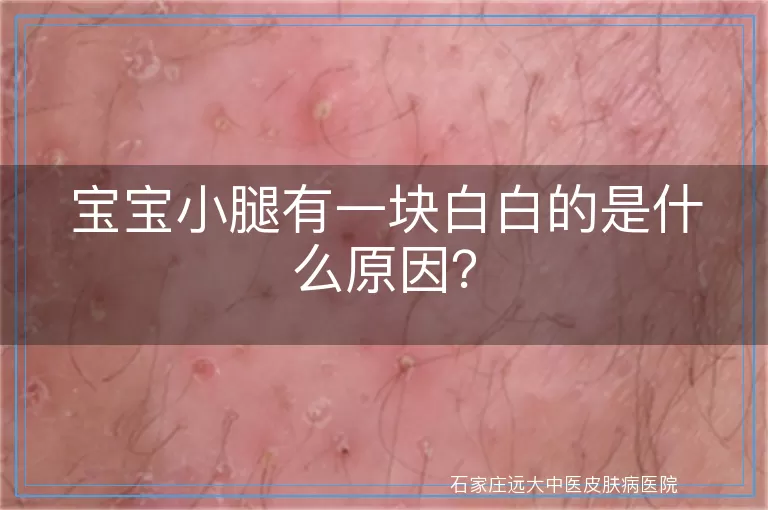 宝宝小腿有一块白白的是什么原因？