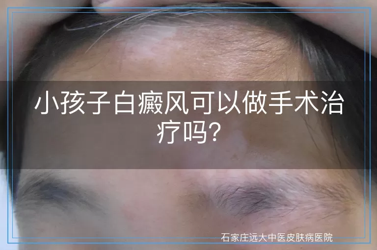 小孩子白癜风可以做手术治疗吗？