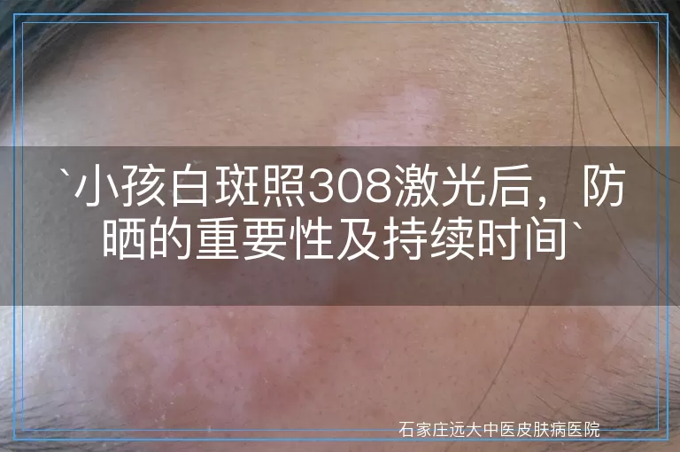 `小孩白斑照308激光后，防晒的重要性及持续时间`