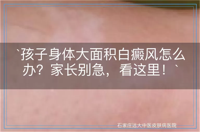 `孩子身体大面积白癜风怎么办？家长别急，看这里！`