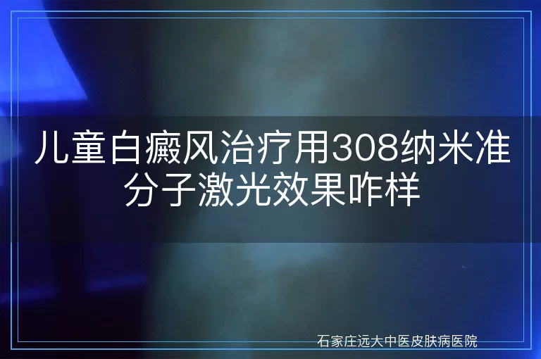 儿童白癜风治疗用308纳米准分子激光效果咋样