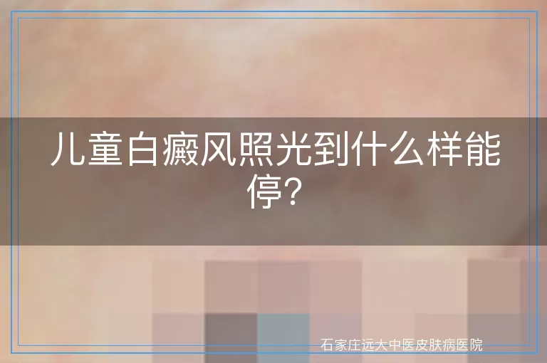 儿童白癜风照光到什么样能停？