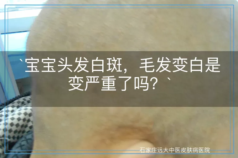 `宝宝头发白斑，毛发变白是变严重了吗？`