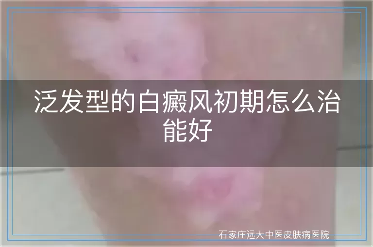 泛发型的白癜风初期怎么治能好