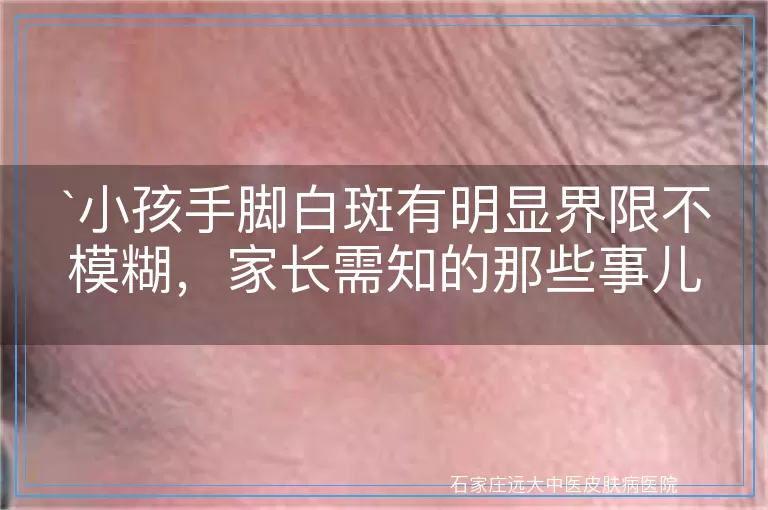 `小孩手脚白斑有明显界限不模糊，家长需知的那些事儿`