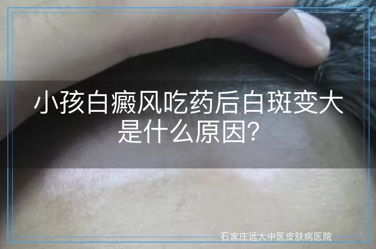 小孩白癜风吃药后白斑变大是什么原因？