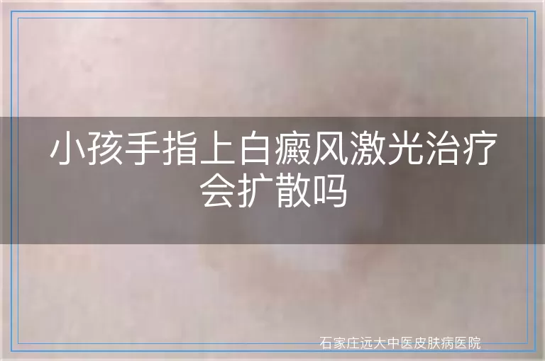 小孩手指上白癜风激光治疗会扩散吗