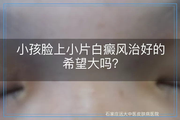 小孩脸上小片白癜风治好的希望大吗？