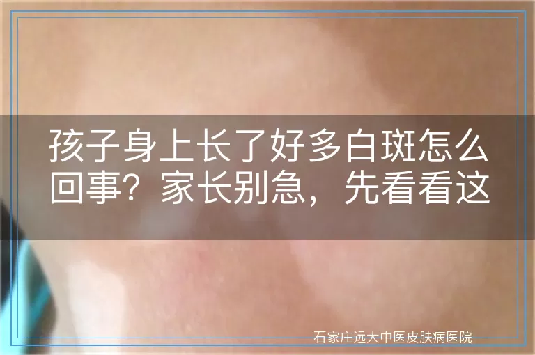 孩子身上长了好多白斑怎么回事？家长别急，先看看这些可能的原因