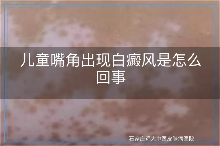 儿童嘴角出现白癜风是怎么回事