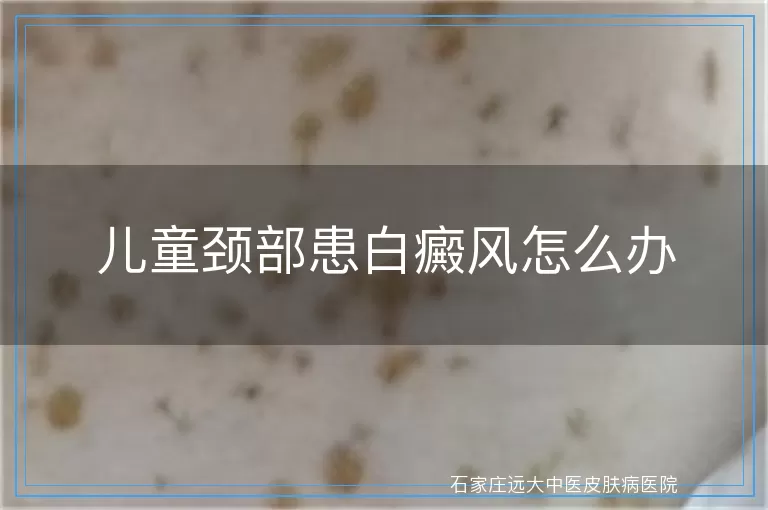 儿童颈部患白癜风怎么办