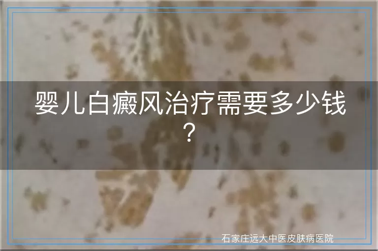 婴儿白癜风治疗需要多少钱？