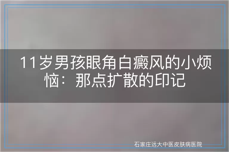 11岁男孩眼角白癜风的小烦恼：那点扩散的印记