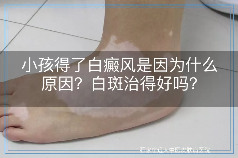 小孩得了白癜风是因为什么原因？白斑治得好吗？