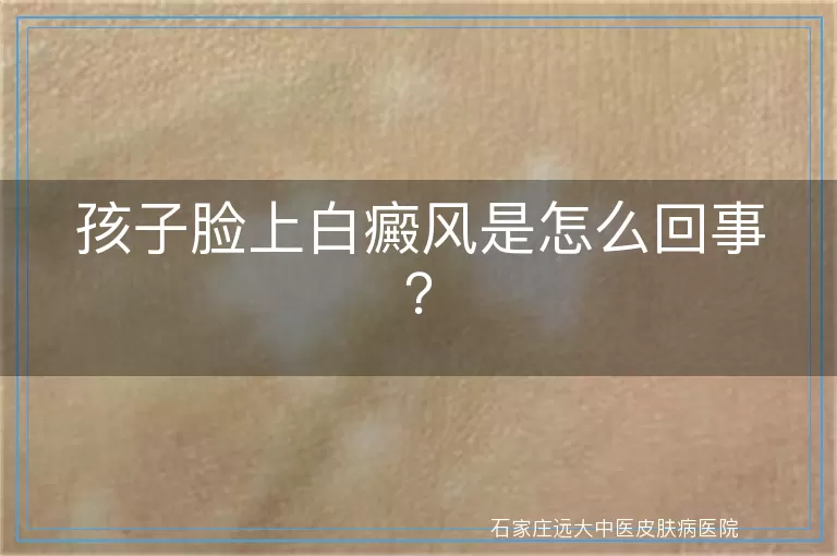 孩子脸上白癜风是怎么回事？