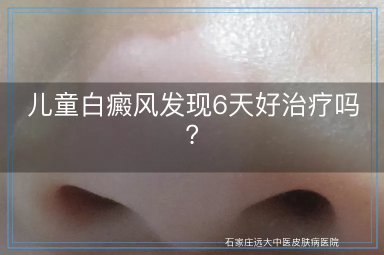 儿童白癜风发现6天好治疗吗？