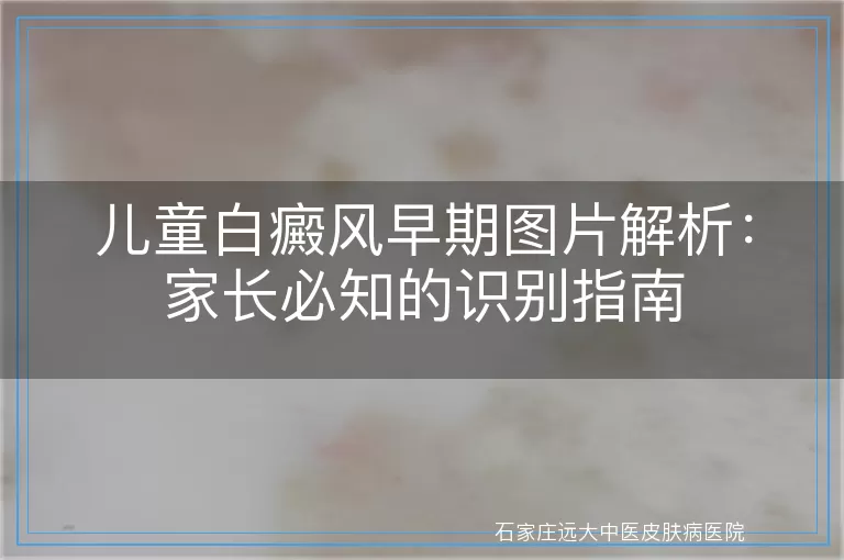 儿童白癜风早期图片解析：家长必知的识别指南