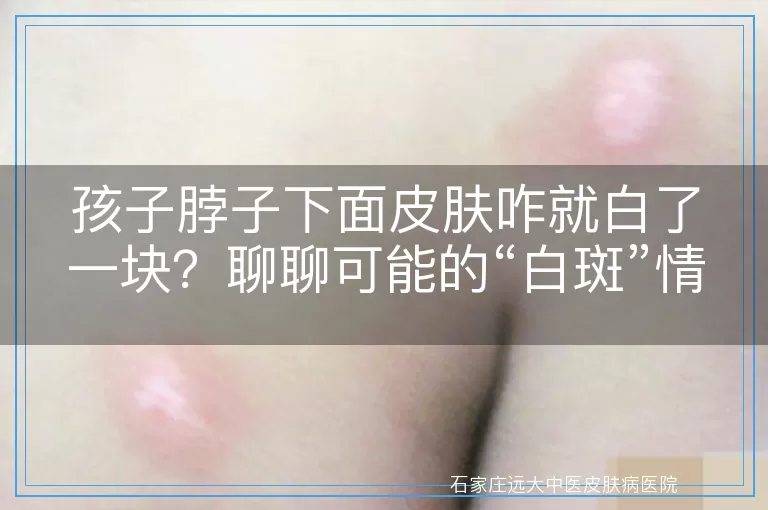 孩子脖子下面皮肤咋就白了一块？聊聊可能的“白斑”情况