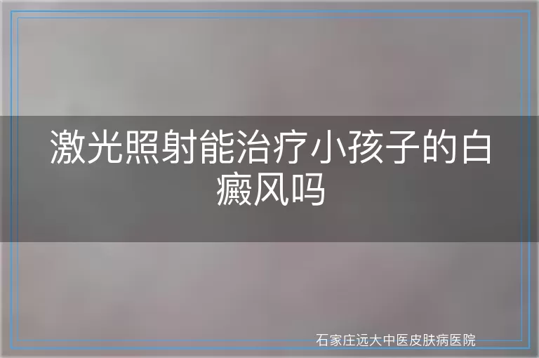 激光照射能治疗小孩子的白癜风吗