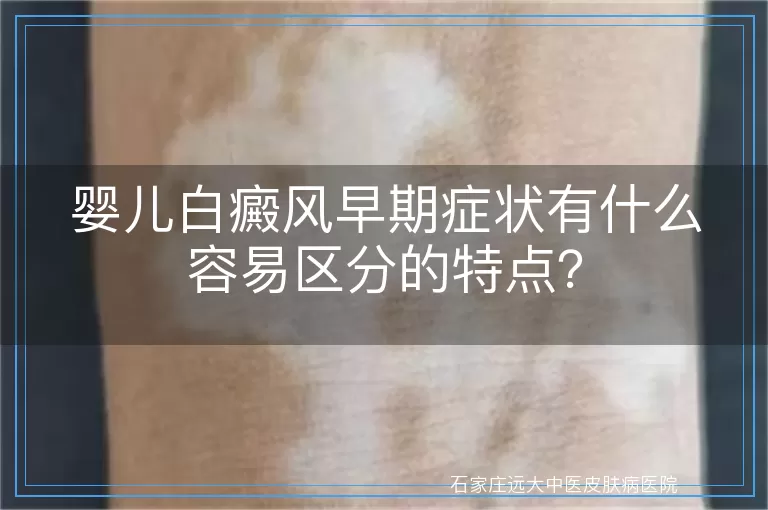 婴儿白癜风早期症状有什么容易区分的特点？