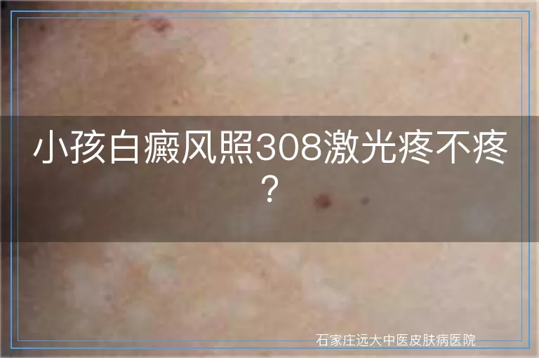 小孩白癜风照308激光疼不疼？