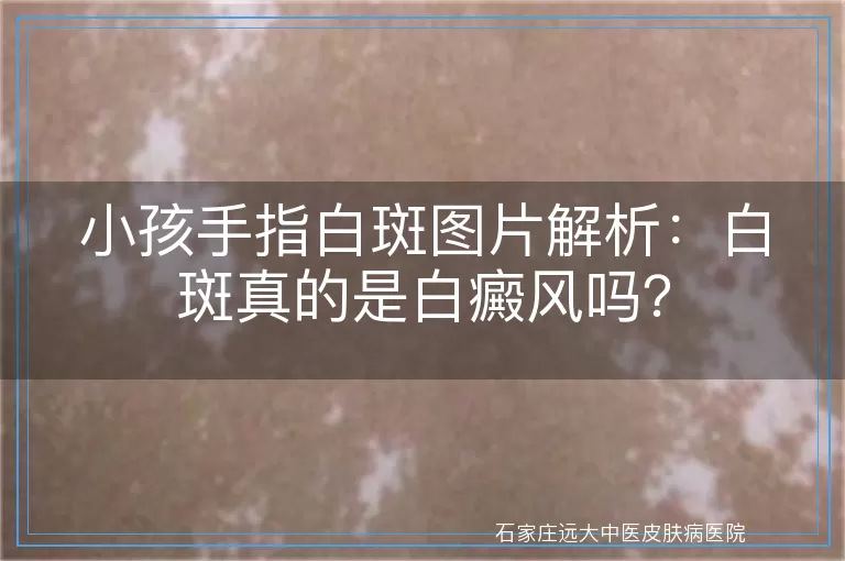 小孩手指白斑图片解析：白斑真的是白癜风吗？