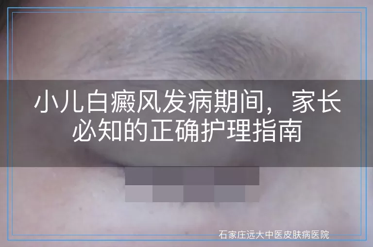 小儿白癜风发病期间，家长必知的正确护理指南