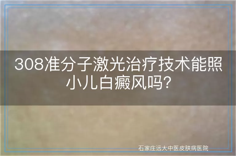 308准分子激光治疗技术能照小儿白癜风吗？