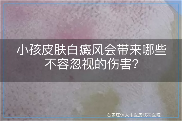 小孩皮肤白癜风会带来哪些不容忽视的伤害？