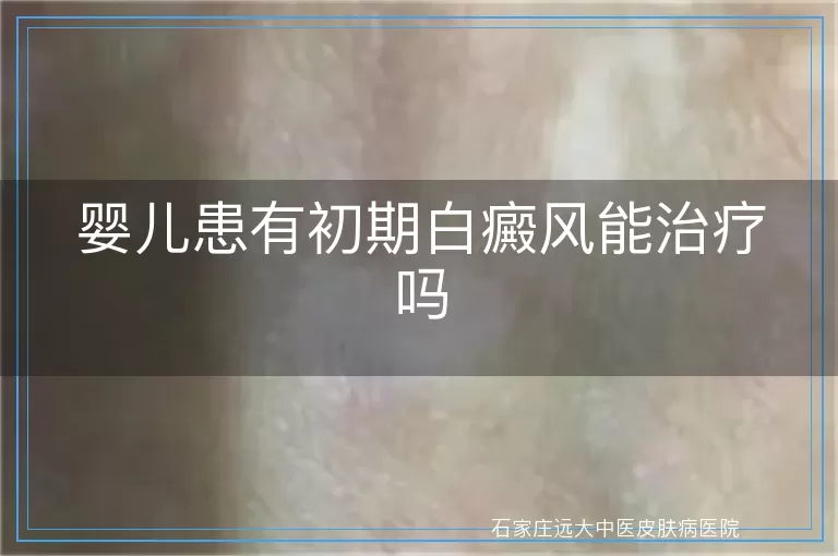 婴儿患有初期白癜风能治疗吗