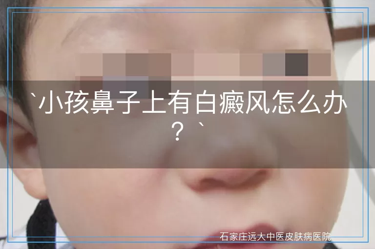 小孩鼻子上有白癜风怎么办？