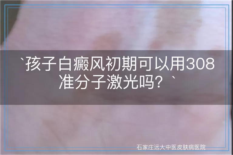 孩子白癜风初期可以用308准分子激光吗？