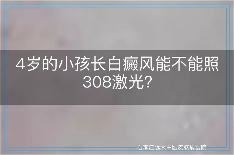 4岁的小孩长白癜风能不能照308激光？