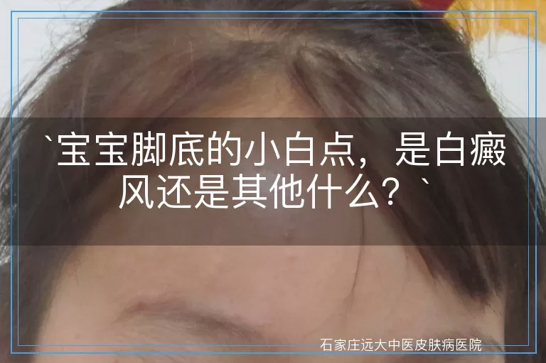 宝宝脚底的小白点，是白癜风还是其他什么？