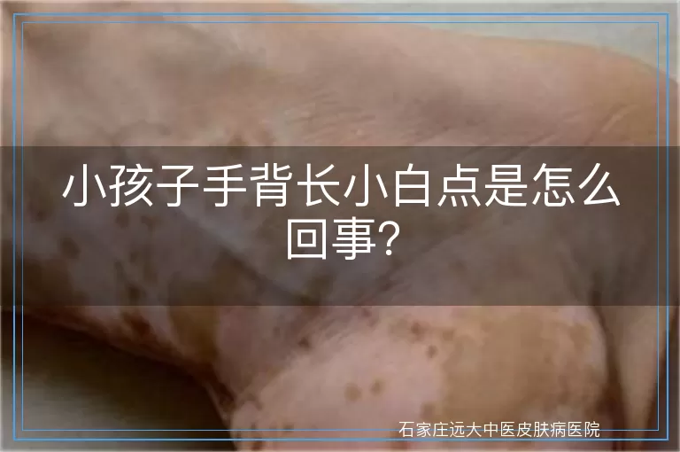 小孩子手背长小白点是怎么回事？