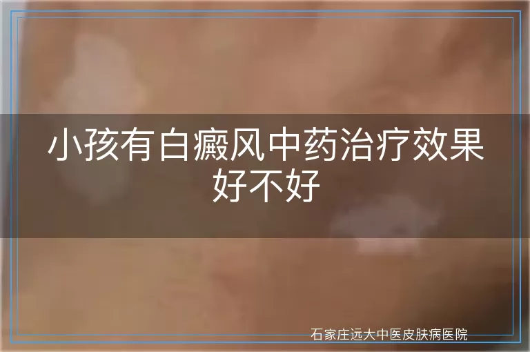 小孩有白癜风中药治疗效果好不好