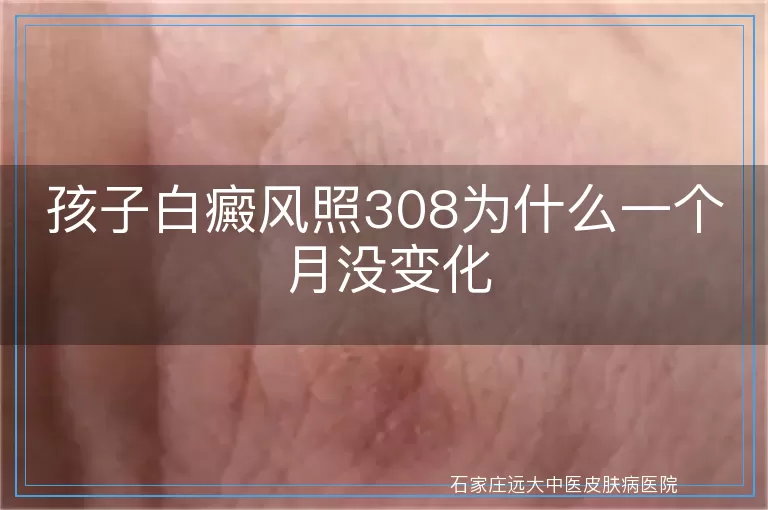 孩子白癜风照308为什么一个月没变化